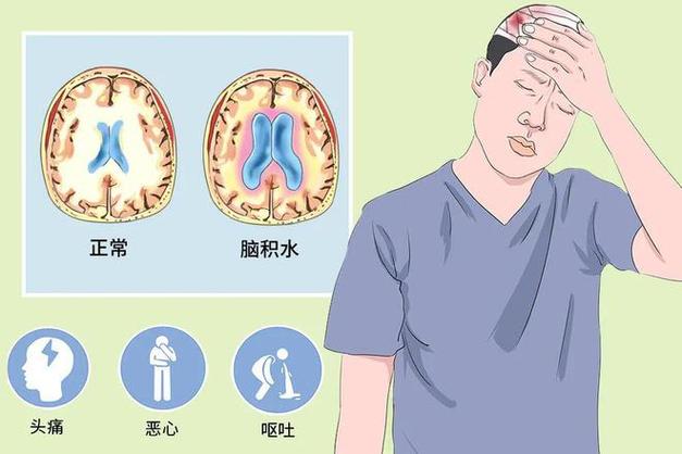 科普|揭秘脑积水:探究“脑子进水”的真相