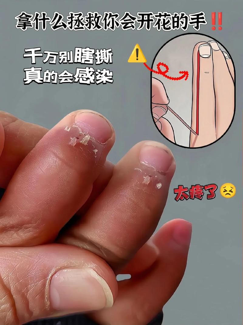 疼疼疼!手上倒刺反复长,真不是缺维生素,而是……